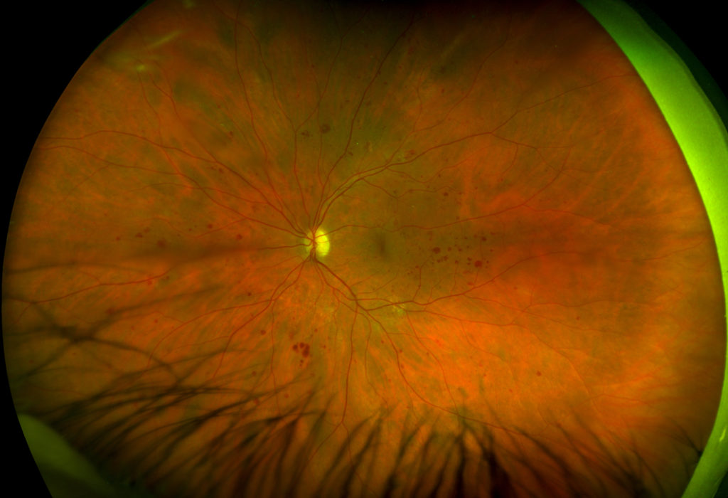 Retinal Imaging